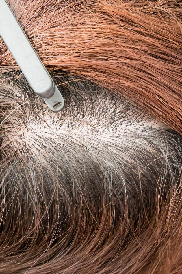 Your One-Stop Solution to Hair Thinning and Balding
