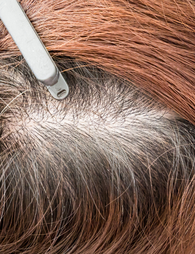 Your One-Stop Solution to Hair Thinning and Balding